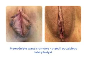 Zdjęcie przerośniętych warg sromowych przed i po zabiegu labioplastyki